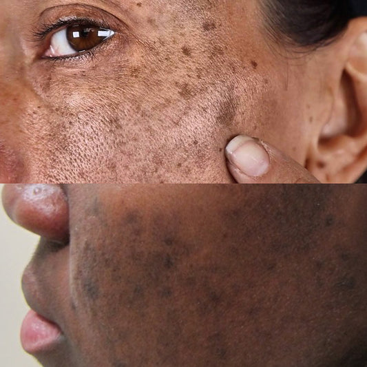 The 411 on Dark Spots